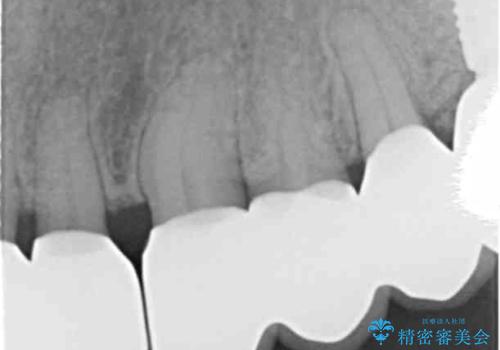 強い咬合力に対抗する歯周補綴の治療後