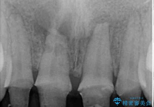 転んでぶつけて抜歯 前歯のオールセラミックブリッジの治療中