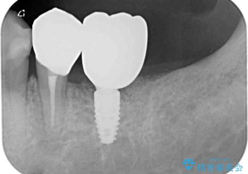 追加のインプラントと、歯肉移植による磨きやすい歯肉に改善の治療前