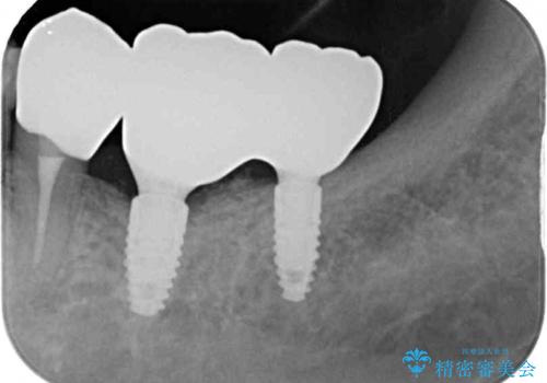 追加のインプラントと、歯肉移植による磨きやすい歯肉に改善の治療後