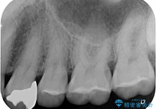 銀歯と樹脂の詰め物のやり替え　セラミックインレーでの治療の治療前