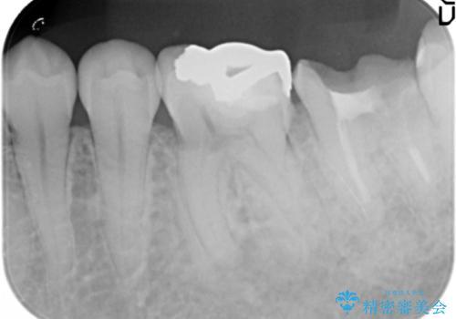 歯科でトラウマ 怖くて行っていなかったが、今度こそきちんと治療したいの治療前