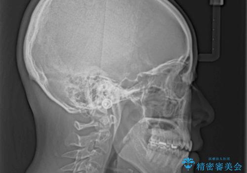 【モニター】狭い上顎歯列とオープンバイト 急速拡大装置を用いた矯正治療の治療前