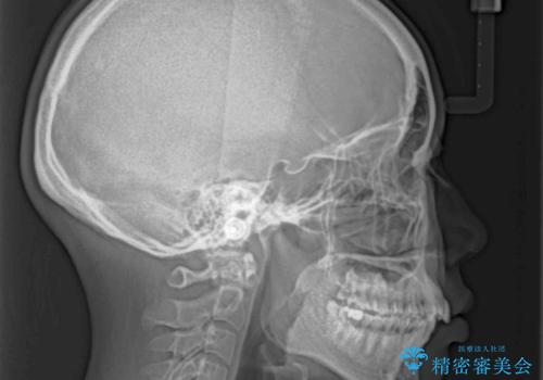 前歯のデコボコを抜歯矯正で改善 メタル装置で費用を抑えるの治療前