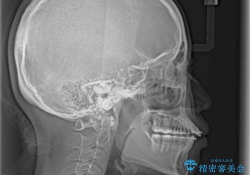 大学病院から転院 非抜歯で口元を下げるワイヤー矯正の治療前