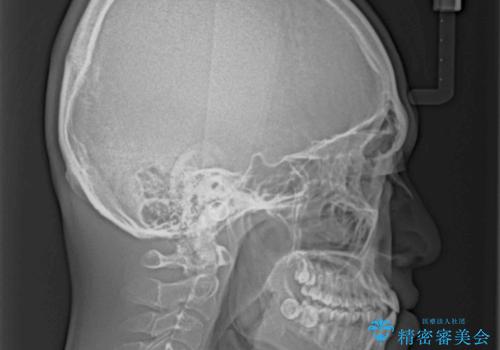 受け口傾向の咬み合わせ インビザラインできれいな口元にの治療前