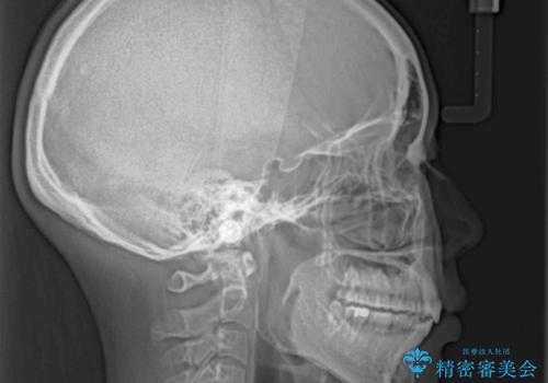 前歯のデコボコを抜歯矯正で改善 メタル装置で費用を抑えるの治療後