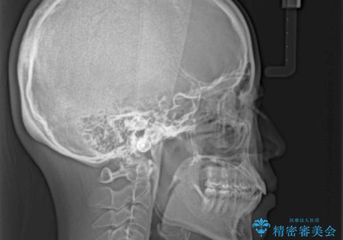 大学病院から転院 非抜歯で口元を下げるワイヤー矯正の治療後