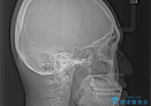 受け口傾向の咬み合わせ インビザラインできれいな口元にの治療後