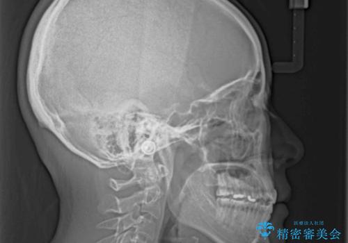 【モニター】狭い上顎歯列とオープンバイト 急速拡大装置を用いた矯正治療の治療後
