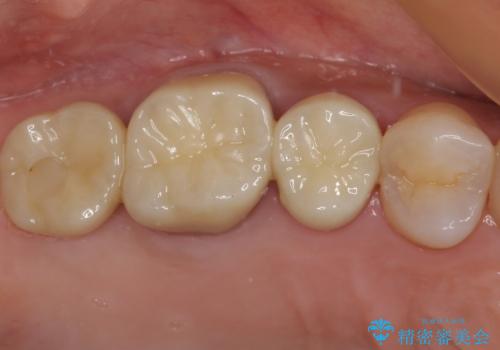 奥歯のセラミックがすぐに壊れる　欠損した奥歯へのインプラント治療の治療後