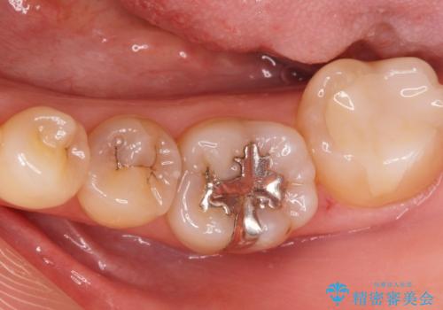 メタルインレーをセラミックインレーに。