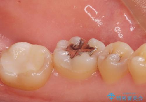 メタルインレーをセラミックインレーに。の治療前