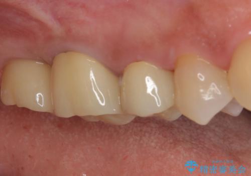 奥歯のセラミックがすぐに壊れる　欠損した奥歯へのインプラント治療