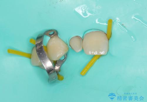 境目が目立つラミネートベニアを作り替えの治療中