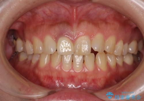 白すぎる前歯と虫歯の奥歯 セラミック治療の治療後