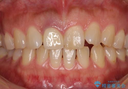 白すぎる前歯と虫歯の奥歯 セラミック治療の治療後