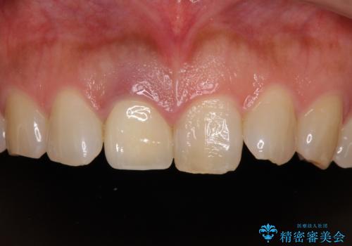 白すぎる前歯と虫歯の奥歯　セラミック治療の症例 治療後