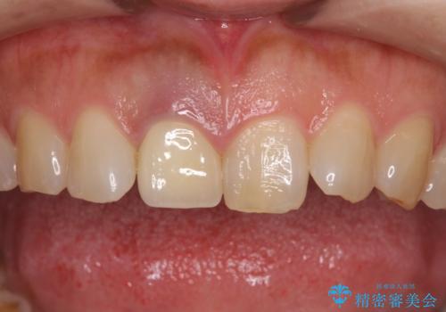 白すぎる前歯と虫歯の奥歯　セラミック治療の治療後