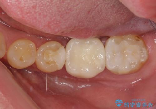 白すぎる前歯と虫歯の奥歯 セラミック治療の治療後