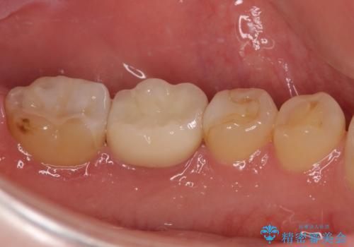 白すぎる前歯と虫歯の奥歯 セラミック治療の治療後