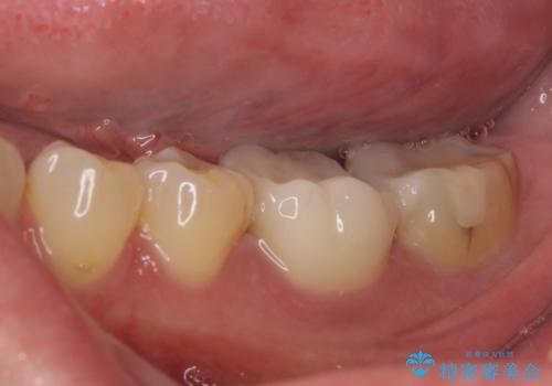 白すぎる前歯と虫歯の奥歯　セラミック治療の治療後