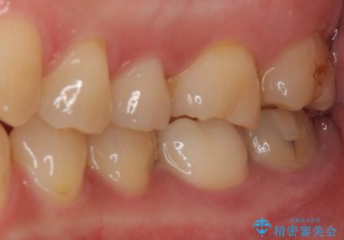白すぎる前歯と虫歯の奥歯 セラミック治療の治療後