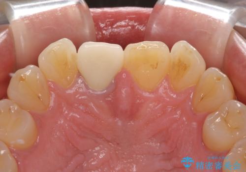 白すぎる前歯と虫歯の奥歯 セラミック治療の治療後