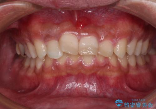 転んでぶつけて抜歯 前歯のオールセラミックブリッジの治療前