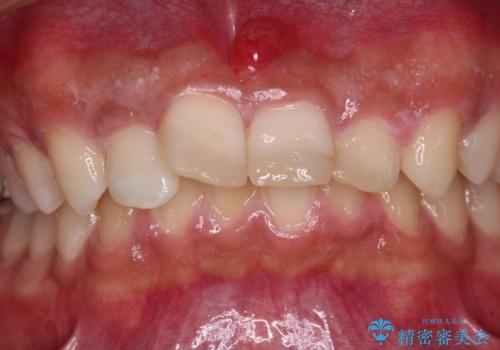 転んでぶつけて抜歯 前歯のオールセラミックブリッジの治療前