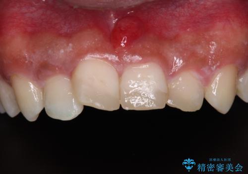 転んでぶつけて抜歯 前歯のオールセラミックブリッジの治療前