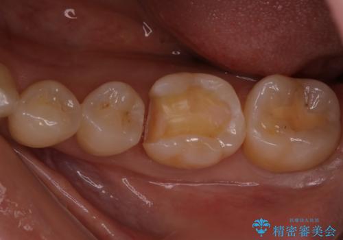 定期検診で虫歯発見。セラミック治療の治療中
