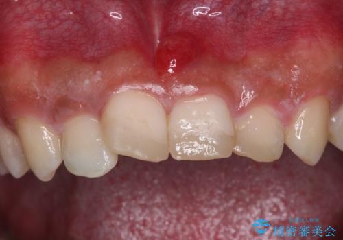 転んでぶつけて抜歯 前歯のオールセラミックブリッジの治療前