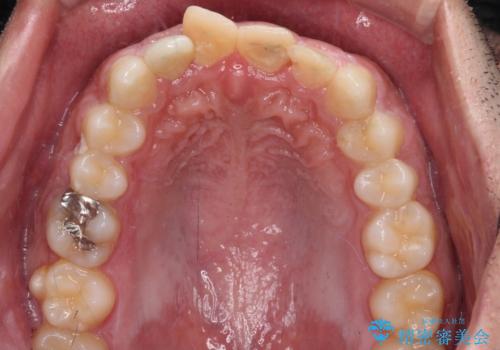 転んでぶつけて抜歯 前歯のオールセラミックブリッジの治療前