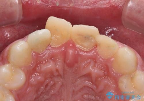 転んでぶつけて抜歯 前歯のオールセラミックブリッジの治療前
