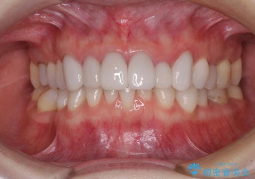 前歯のデコボコと奥歯の咬み合わせをインビザラインで改善の症例 治療前
