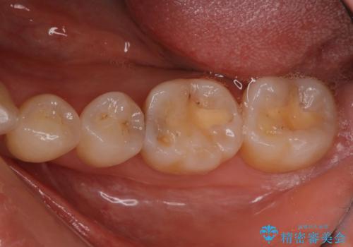 定期検診で虫歯発見。セラミック治療の治療前