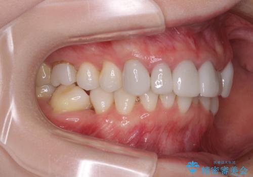 前歯のデコボコと奥歯の咬み合わせをインビザラインで改善の治療前