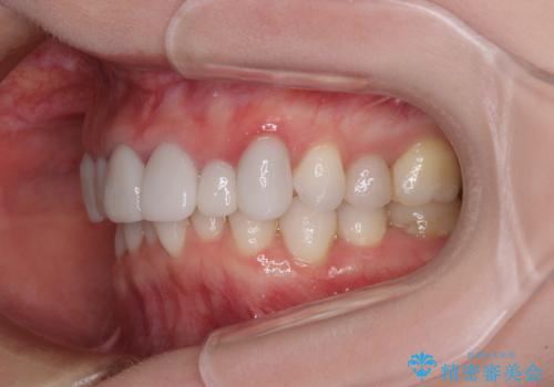 前歯のデコボコと奥歯の咬み合わせをインビザラインで改善の治療前