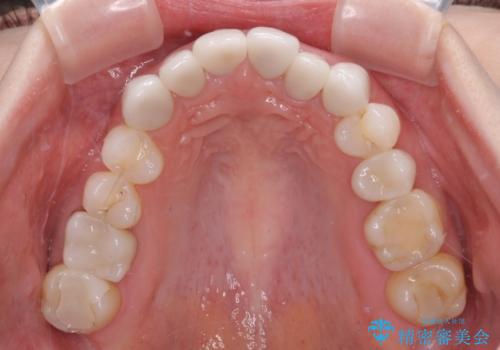 前歯のデコボコと奥歯の咬み合わせをインビザラインで改善の治療前