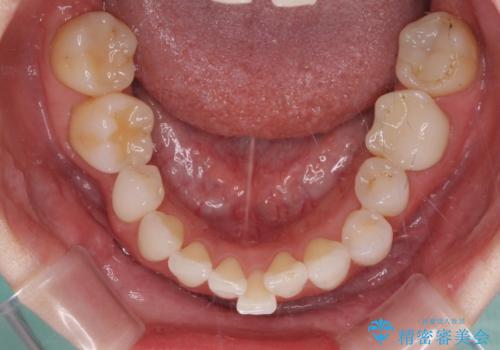 前歯のデコボコと奥歯の咬み合わせをインビザラインで改善の治療前
