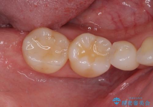 前歯のデコボコと奥歯の咬み合わせをインビザラインで改善の治療前