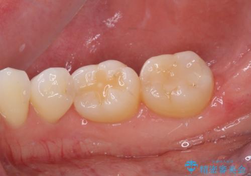 前歯のデコボコと奥歯の咬み合わせをインビザラインで改善の治療前