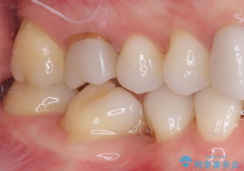 前歯のデコボコと奥歯の咬み合わせをインビザラインで改善の治療前