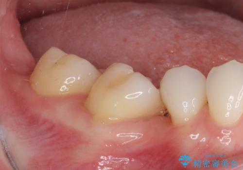 前歯のデコボコと奥歯の咬み合わせをインビザラインで改善の治療前