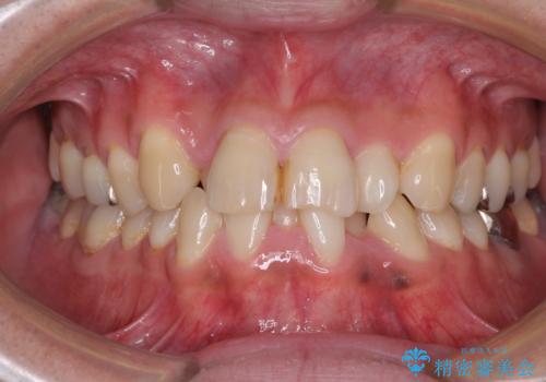 重なって磨きにくい上下の前歯 ワイヤー装置での抜歯矯正の治療前