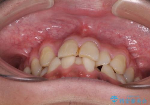 重なって磨きにくい上下の前歯 ワイヤー装置での抜歯矯正の治療前