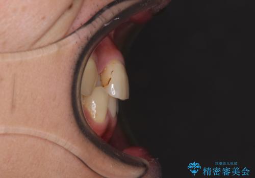 重なって磨きにくい上下の前歯 ワイヤー装置での抜歯矯正の治療前