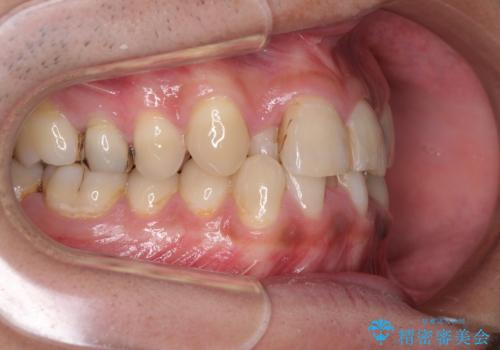 重なって磨きにくい上下の前歯 ワイヤー装置での抜歯矯正の治療前