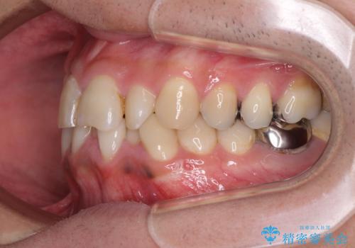 重なって磨きにくい上下の前歯　ワイヤー装置での抜歯矯正の治療前